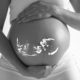 Radiation Pregnant Birth Defect